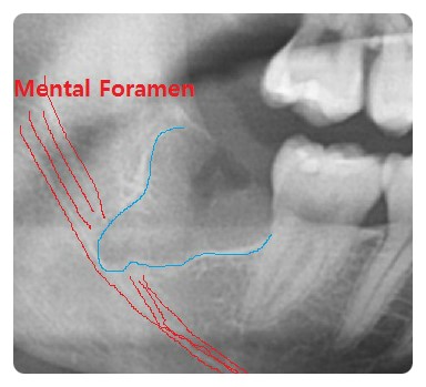 학동역 사랑니발치 관련 이미지 3