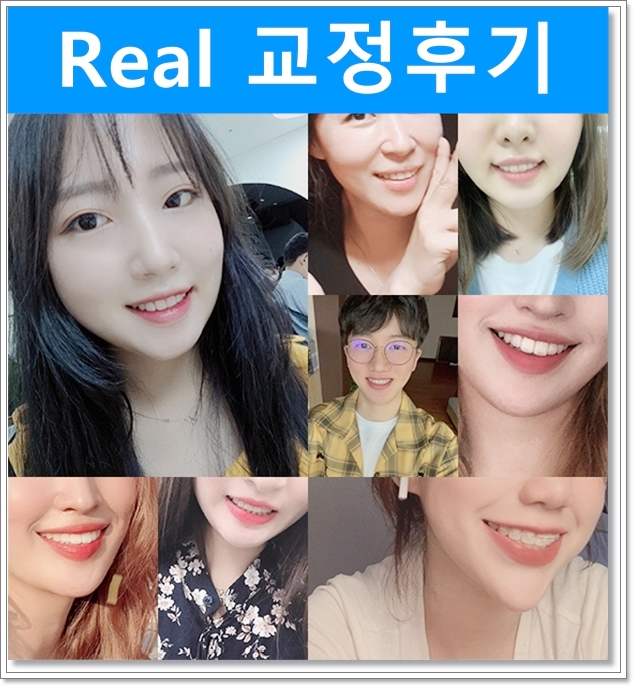 돌출입과 치아배열 치아교정전후 관련 이미지 3