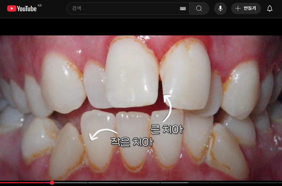 앞니 중심선 안맞으면, 안면비대칭인가요? [치아교정 필요한 예시] 관련 이미지 2