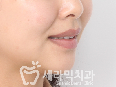 토끼이빨, 틀어진 치아배열 세라믹교정 전후사진 관련 이미지 18