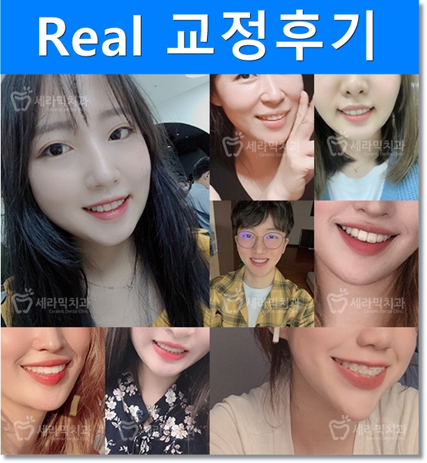 돌출입 치아교정을 통해, 매력적인 옆 라인으로 변신! 관련 이미지 4