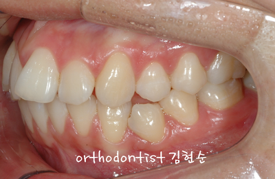 강남 돌출 관련 이미지 7