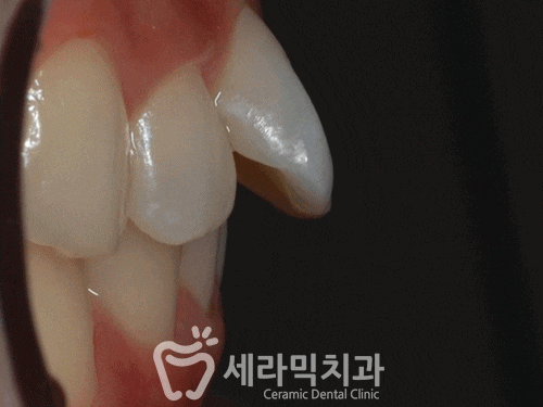 나비치아, 앞니돌출, 과개교합 치아교정전후 관련 이미지 5