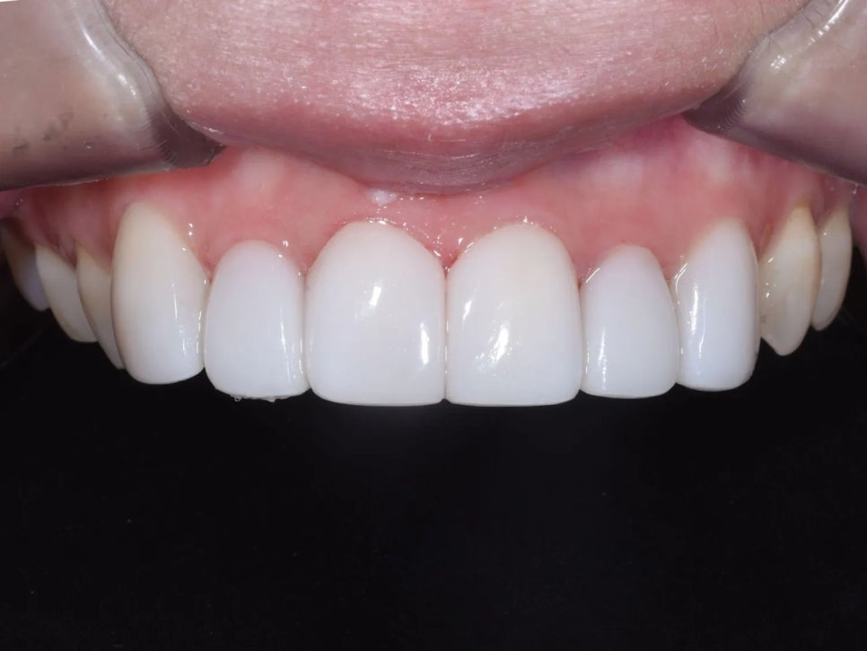 세라믹 치과, 삐뚤빼뚤한 치아를 교정 없이 라미네이트로 치료한 사례 관련 이미지 7