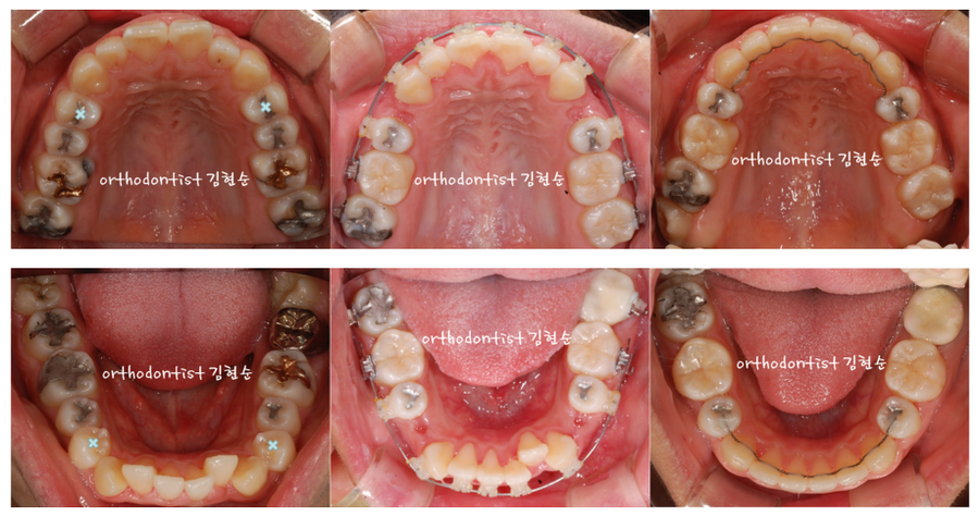 미니스크류, 돌출입 발치 교정 잇몸노출 개선 관련 이미지 8