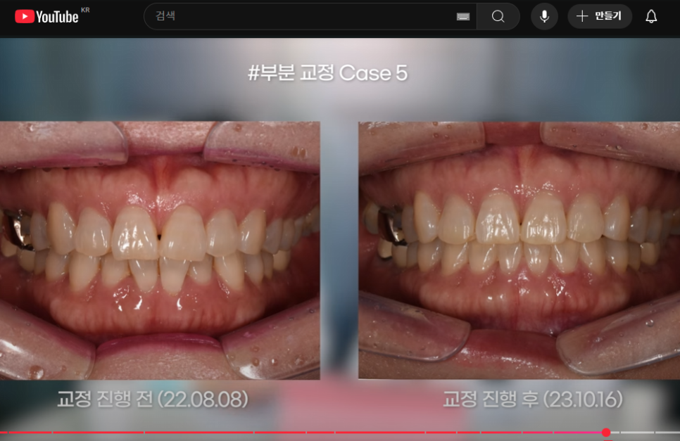 토끼이빨 앞니 부분교정, 실패하지 않는 방법은 관련 이미지 5