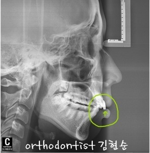 강남 돌출입 교정 관련 이미지 40