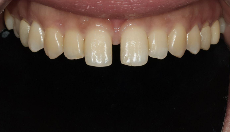 앞니 벌어짐, 교정 없이 라미네이트로 해결한 경우 관련 이미지 2