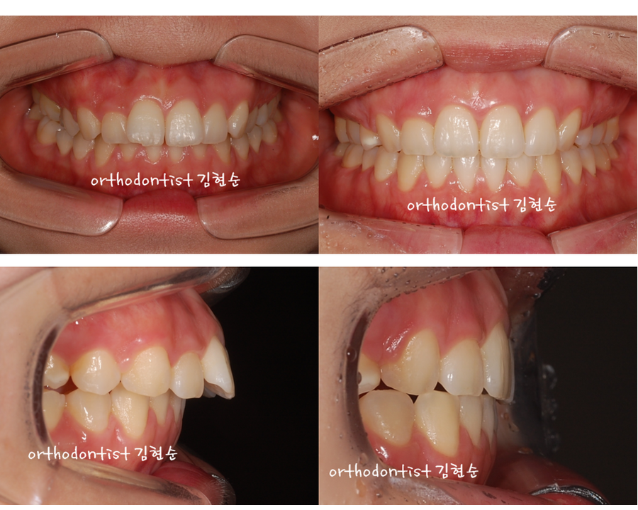 세라믹교정 세라믹치과-돌출입발치교정 2 관련 이미지 6