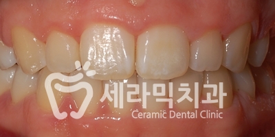 돌출입 잇몸노출 치아교정 전후 인상변화 사례 관련 이미지 13