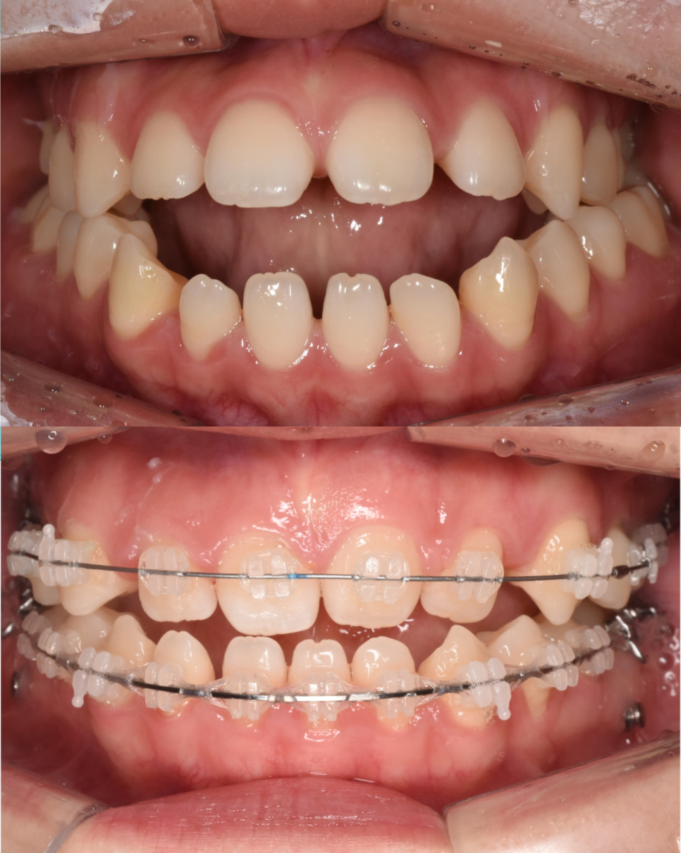 학동역 교정치과, 개방교합과 비대칭을 수술없이 교정한 경우 관련 이미지 9
