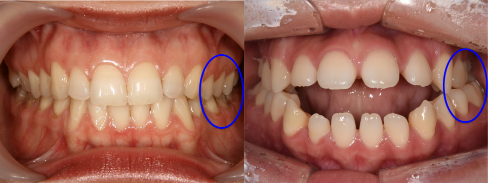 학동역 교정치과, 개방교합과 비대칭을 수술없이 교정한 경우 관련 이미지 3
