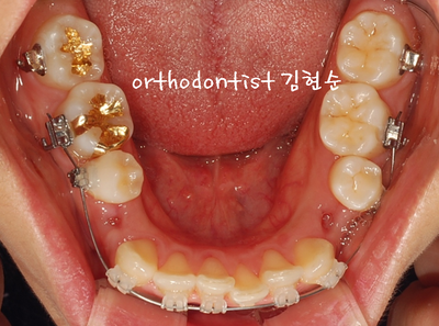 강남 돌출 관련 이미지 18