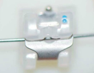 강남 교정치과 클리피씨 교정이 비싼 이유 관련 이미지 2