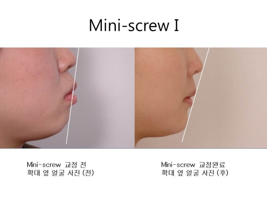 학동역치과 치아교정 잘하는 곳 ! 관련 이미지 19