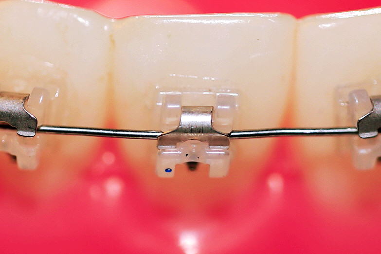 클리피씨 교정 월17만에 ~ 관련 이미지 5