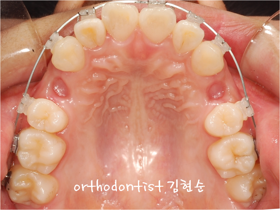 세라믹교정 은 세라믹치과 발치비발치 해결 관련 이미지 5