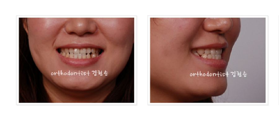 주걱턱수술 안하고 양악수술 안하고 관련 이미지 8