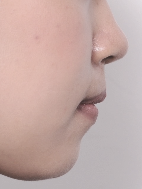 학동역치과 하면 세라믹교정 ~ 관련 이미지 13