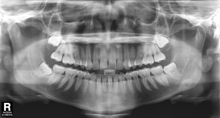 학동역 사랑니발치 관련 이미지 8