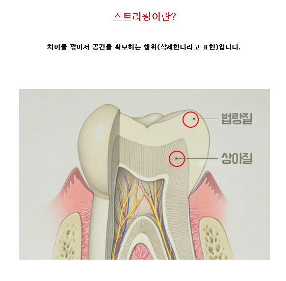 비발치교정 스트리핑이 필요 관련 이미지 5
