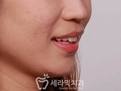치아교정전후, 돌출입치아교정으로 변화한 얼굴! 관련 이미지 1