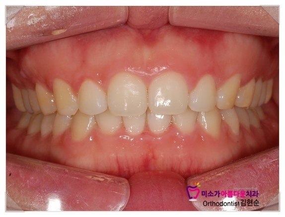 과개교합 교정 후기 세라믹교정치과 관련 이미지 2