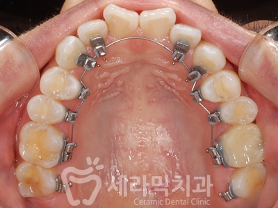 치아교정 부작용, 결과 불만족 고민 해결사, 세라믹치과 관련 이미지 9