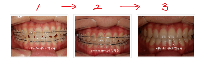 주걱턱수술 안하고 양악수술 안하고 관련 이미지 13