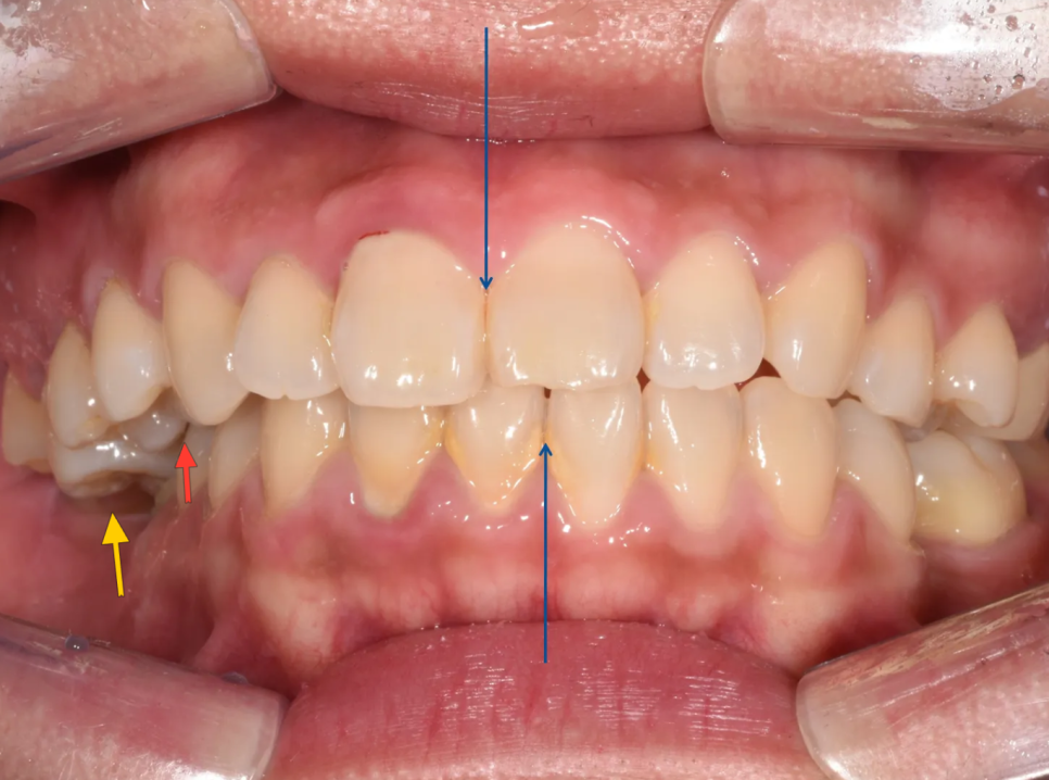 돌출입 교정 전후, 그런데 과개교합까지 있으셨던 환자분 관련 이미지 2