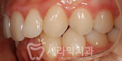 과개교합 치아교정잘하는곳, 세라믹치과 치아교정전후! 관련 이미지 13