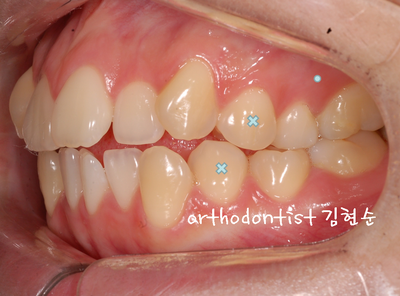 치열 교정(치열 불규칙) 관련 이미지 19