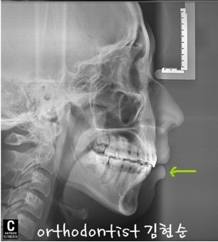 강남 돌출입 교정 관련 이미지 41