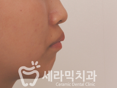 치아교정 전후 스마일라인 변화!(돌출입,토끼앞니, 중심선 비대칭 동시 교정) 관련 이미지 8