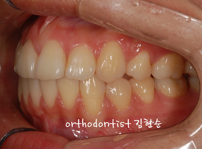 강남 돌출 관련 이미지 22