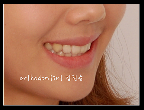 강남교정치과 관련 이미지 36