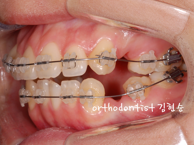 치열 교정(치열 불규칙) 관련 이미지 24