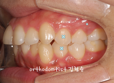 강남 돌출 관련 이미지 15