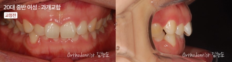 과개교합 무턱 개선 관련 이미지 5