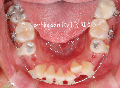 강남 돌출 관련 이미지 21