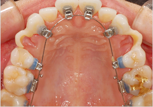 세라믹교정 세라믹치과 - 콤비네이션 교정이란 ? 관련 이미지 4