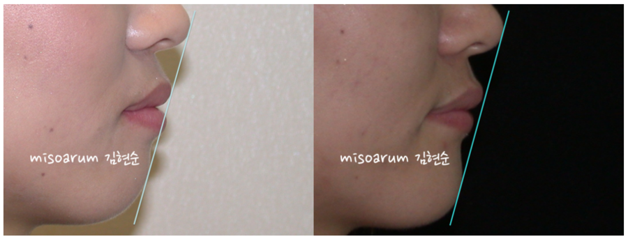 세라믹교정 덧니교정 관련 이미지 10