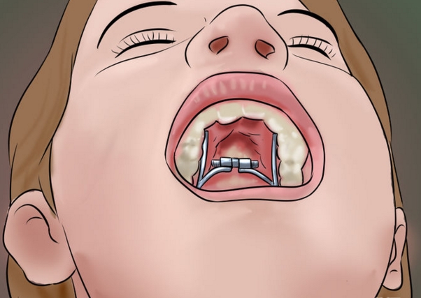 돌출입교정 / 기간 / 비용 관련 이미지 1