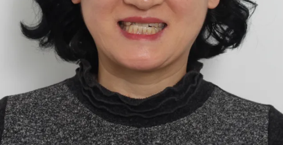 50대 치아교정 사례: 평생의 콤플렉스였던 앞니 반대교합 관련 이미지 2