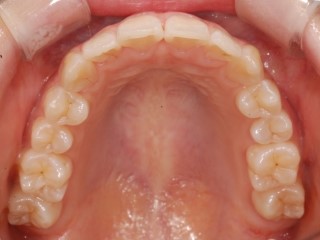 세라믹교정 세라믹치과 - 아나운서 교정이 뭘까요 ? 관련 이미지 13