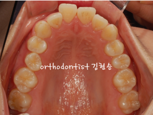 강남 돌출입 교정 관련 이미지 3