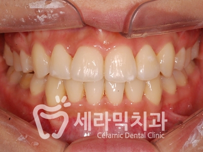 토끼이빨, 틀어진 치아배열 세라믹교정 전후사진 관련 이미지 16
