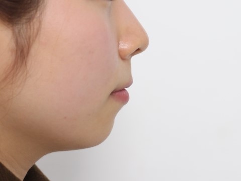 세라믹치과 홍수빈님 다시교정하기 관련 이미지 7