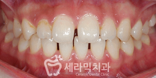 벌어진치아 세라믹교정 치아교정전후 세라믹치과 관련 이미지 4
