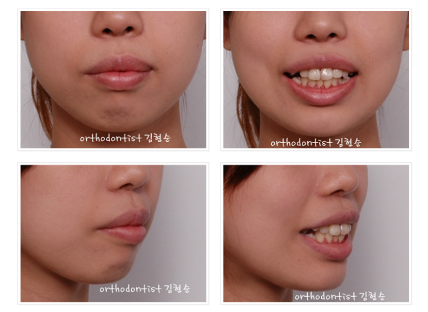 돌출입 발치교정, 미니스크류를 통한 6가지 변화 관련 이미지 5